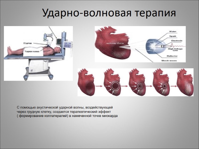 Ударно-волновая терапия  С помощью акустической ударной волны, воздействующей через грудную клетку, создается терапевтический